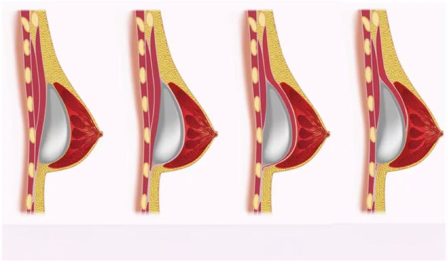 access for implant placement